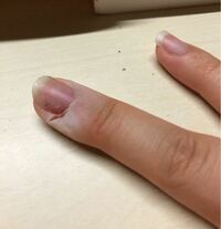 昨日カッターで指を切ってしまいました 結構深く切ったのですが Yahoo 知恵袋