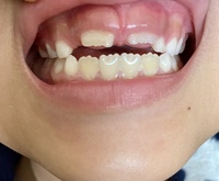 子供の前歯隙間についてです 前歯2本と下の歯4本の永久歯が生えてきましたが 前 Yahoo 知恵袋