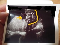 19週5日のエコー画像 男の子 女の子 どちらに見えますか 男の子シ Yahoo 知恵袋