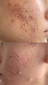 肌汚くてすいません 結構重症なんでしょうか ニキビ跡の赤みは美容 Yahoo 知恵袋