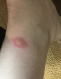 蚊にしては 足首が結構腫れて一昨日から痒みがなかなかおさまらないので Yahoo 知恵袋