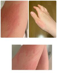 蕁麻疹 これがなんなのかわかりません もともとお風呂から上がる Yahoo 知恵袋