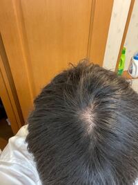 最近頭が痒いんですがこれってつむじハゲですか 失礼します 拡大してみると Yahoo 知恵袋