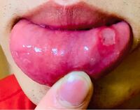 めちゃでかい口内炎ができてしまいました どうすれば早く治ります Yahoo 知恵袋