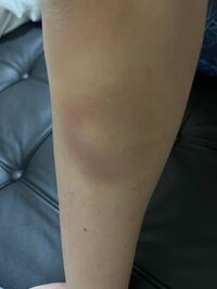 朝起きたらこのような輪っか型のあざができていました 真ん中の白いところは少 Yahoo 知恵袋