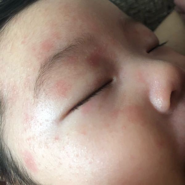 至急ご回答頂けると有難いです 写真は生後2ヶ月半の娘です 顔に Yahoo 知恵袋