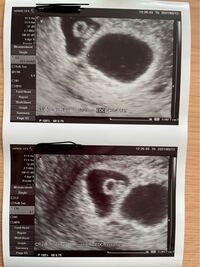 体外受精で二卵性の双子を妊娠しました 昨日6w6dの診察で1人は心拍確認 Yahoo 知恵袋