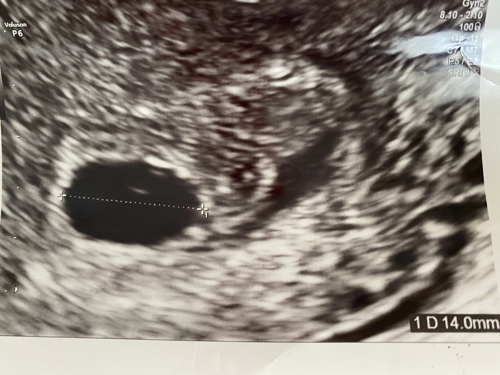 胎芽が確認できないです 現在 妊娠アプリでは7w5dです 5w頃初診 Yahoo 知恵袋