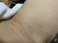 お見苦しいお写真を失礼します ここ最近 太ももやお尻 下腹部などに Yahoo 知恵袋