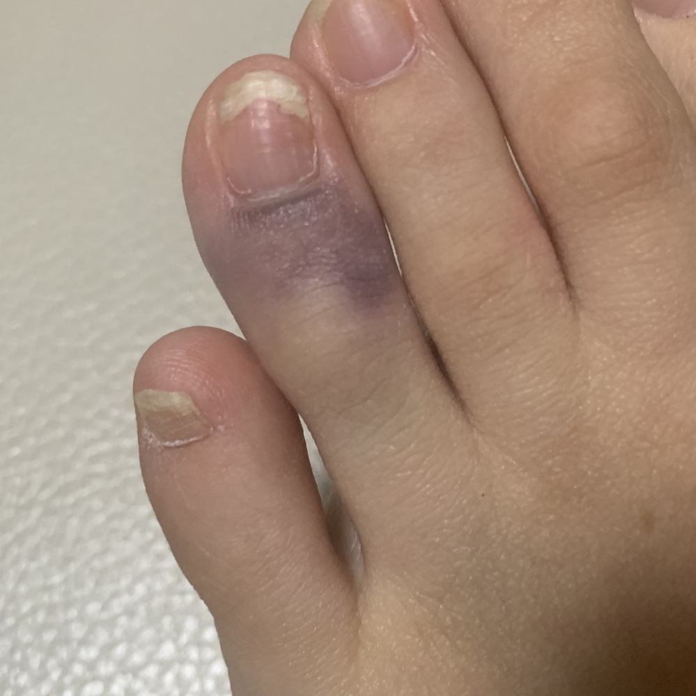 足 の 小指 ぶつけ た 紫