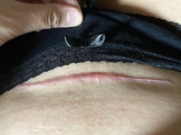 画像あり閲覧注意 帝王切開で出産して6ヶ月が経ちます 最近 傷がかゆいです Yahoo 知恵袋