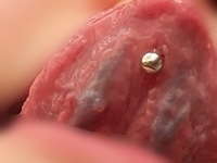 閲覧注意？舌ピアスについて 舌ピを開けたのですが裏側の位置は大丈夫でしょうか？裏筋の線がいまいちわかりません。もし良くないようでしたら開け直すので教えてください。