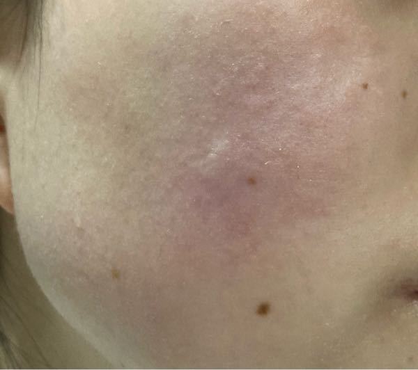 この肌のボコボコ感 原因は何だと思いますか ここ2 3日顔が痒く 乾燥も Yahoo 知恵袋