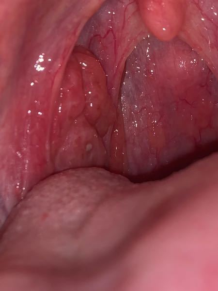 喉ちんこの近くに白くプツッとできました 臭い玉かなと押し出してみたのですが 何 Yahoo 知恵袋