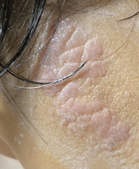 首の後ろの湿疹について 汚い画像すみません 時たますごく痒くなります 保 Yahoo 知恵袋