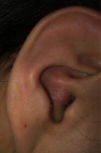 百科事典 預言者 行進 耳 の 穴 腫れ イヤホン Eigolesson Jp