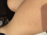 注意 汚いです膝の毛穴 がボツボツと膨れています立体の毛穴みたいな感 Yahoo 知恵袋