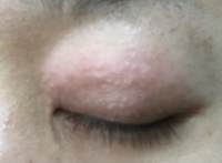 まぶたと腕のかぶれ についての質問です 木曜日の朝左まぶたが腫れてい Yahoo 知恵袋