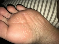 足裏の皮が剥けて2ヶ月ほど治りません これって水虫ですか Yahoo 知恵袋