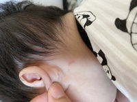 5ヶ月の赤ちゃんなんですが 朝見ると耳の後ろに噛まれた跡がありました Yahoo 知恵袋