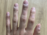 これはひょう疽でしょうか 爪の付け根がいつも腫れて冷やさないと猛烈に痒いです Yahoo 知恵袋