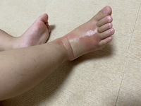 子供の足が昨日保育園で腫れたらしく こんな感じになっているのですがこれは何でし Yahoo 知恵袋