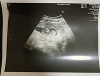 妊娠12w経産婦23歳です 妊婦検診後自宅でエコーの写真を見ていたら首の後ろに Yahoo 知恵袋