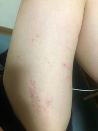 閲覧注意 わたしは元々アレルギー体質かつアトピー体質なのですが お風呂 Yahoo 知恵袋