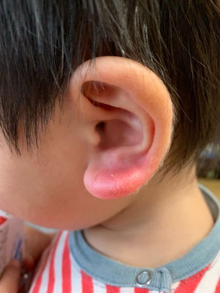 耳の病気 すべての質問 Yahoo 知恵袋