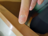 この爪のでごぼこは手荒れからなってるものですか 手荒れをしやすいため 定 Yahoo 知恵袋