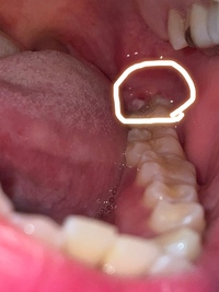 口の中の画像注意 奥歯の歯茎の痛み3日前から1番奥の歯茎が痛みます 首 Yahoo 知恵袋