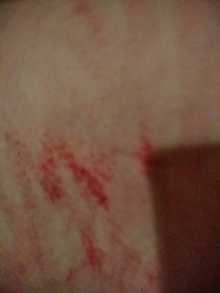 脇が痒くてかいたら赤くなりました かきすぎなんでしょうか 痒みはちゃ Yahoo 知恵袋