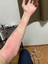 お酒飲んでたら身体がまだら模様に赤くなりました これって平気です 今までこ Yahoo 知恵袋