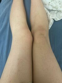 閲覧注意大学一年の女です 遺伝で足がぶつぶつなのですが この足でミニ Yahoo 知恵袋