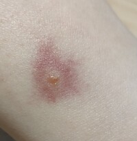 肌注意この虫刺されはなんの虫でしょうか 足首と腰のあたりに噛まれた Yahoo 知恵袋
