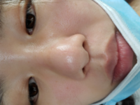 団子鼻ですか 脂肪溶解注射でマシになりますか Yahoo 知恵袋