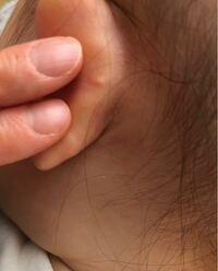 ２歳の娘の耳の裏に写真のような小さいしこりができていました できてか Yahoo 知恵袋