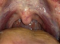 喉の軽い痛みが10日くらい続くのですが 私の扁桃腺って腫れてるんでし Yahoo 知恵袋