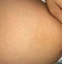 閲覧注意 お尻と太ももの裏の間がざらざらしてして汚いです お尻用の Yahoo 知恵袋