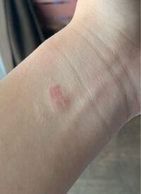 男です 手首辺りに写真のように蚊に刺されたような感じの湿疹がここ3週間ぐらい治 Yahoo 知恵袋