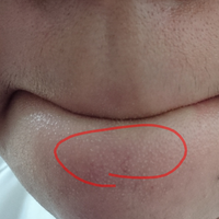 顎の角栓どうにかしたい 毎日洗顔してるのに全然綺麗にならない Yahoo 知恵袋