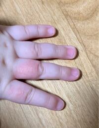 8ヶ月の子供の指にぶつぶつが出て 少し腫れていて熱を持ってます 特に変わっ Yahoo 知恵袋