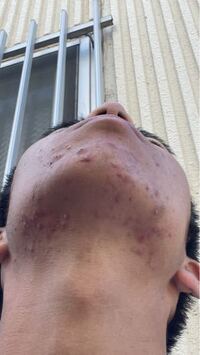 最近顎の下のニキビが酷くなりました 皮膚科の薬を使ってもどうしても良くなり Yahoo 知恵袋