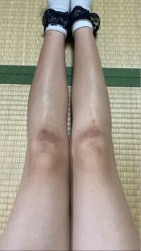 膝黒くて汚いです 何故こんな汚くなりますか 膝の黒ずみを取る方法を教えてく Yahoo 知恵袋