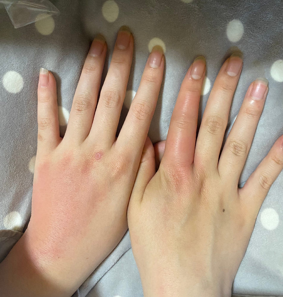 皮膚の病気 アトピー 投票受付中の質問 Yahoo 知恵袋