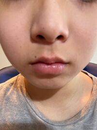 ホクロの毛について 口元に２ミリほどの小さなホクロがあります 前日まで黒い毛 Yahoo 知恵袋