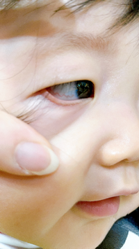 生後7ヶ月の赤ちゃんで 片目の1本だけ血管が浮いています たまになっていると思 Yahoo 知恵袋
