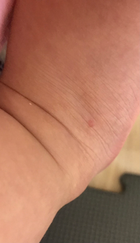生後10ヶ月の女の子の子育て中です右と左の足の甲に合計湿疹が4つあり Yahoo 知恵袋