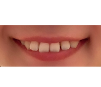 歯科矯正の失敗 不安について 6年程前から歯科矯正に通っています 2 Yahoo 知恵袋