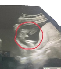 妊娠5ヶ月目のエコー写真です 男の子でしょうか 分かる方いらっしゃいますか Yahoo 知恵袋